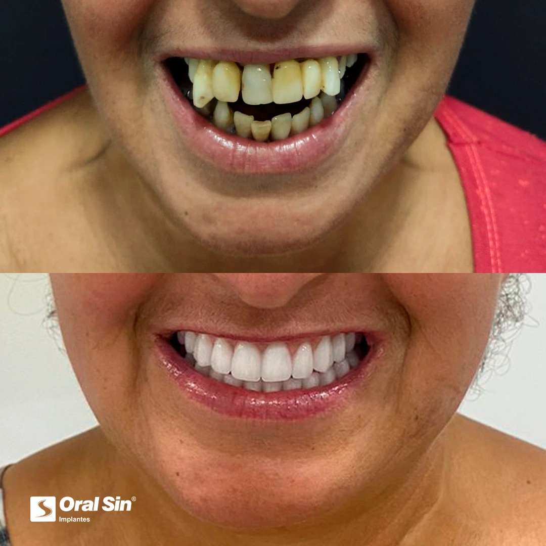Paciente real — antes e depois 1
