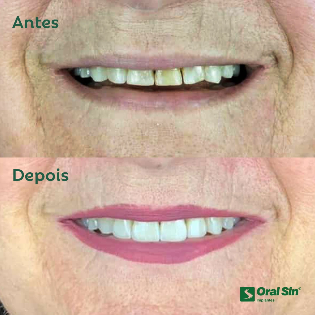Paciente real — antes e depois 4