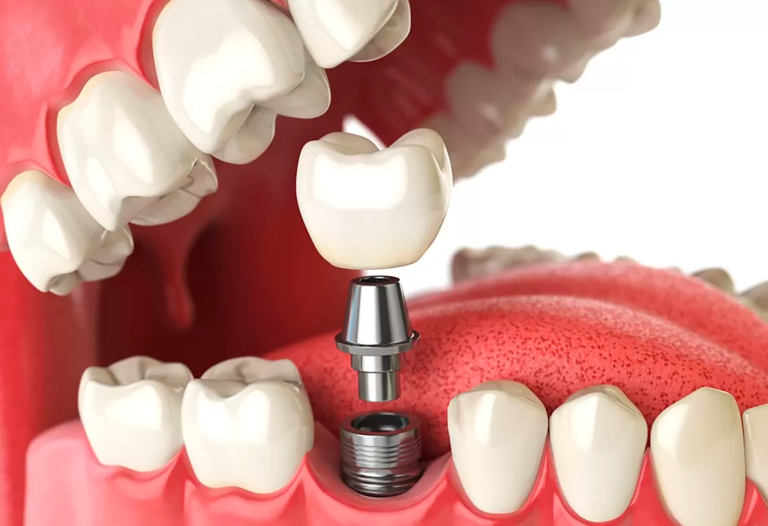 Implantes Dentários